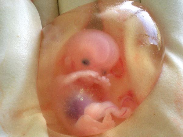 Human, 10 weeks in womb in amniotic sac, from therapeutic abortion. From: http://bioethicstoday.wordpress.com/2013/03/03/fetal-maiming-an-argument-for-the-value-of-potential